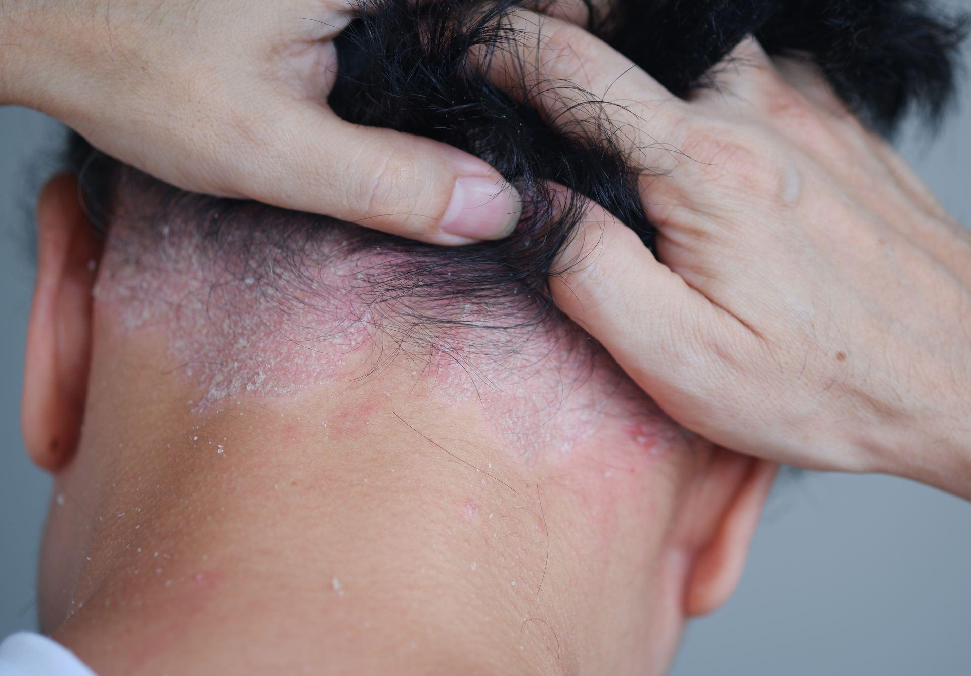 Seborrheic Dermatitis image