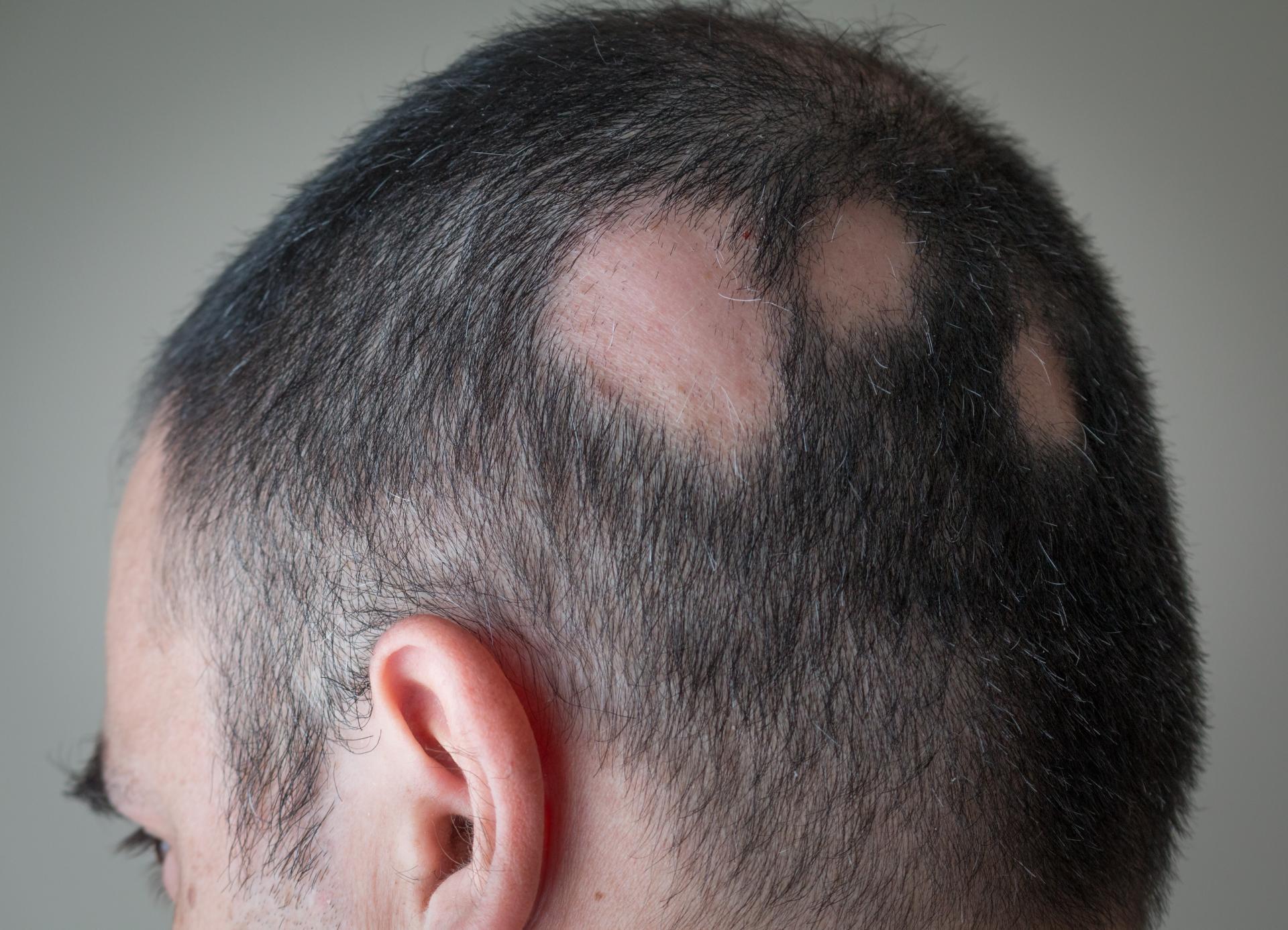 Alopecia Areata image