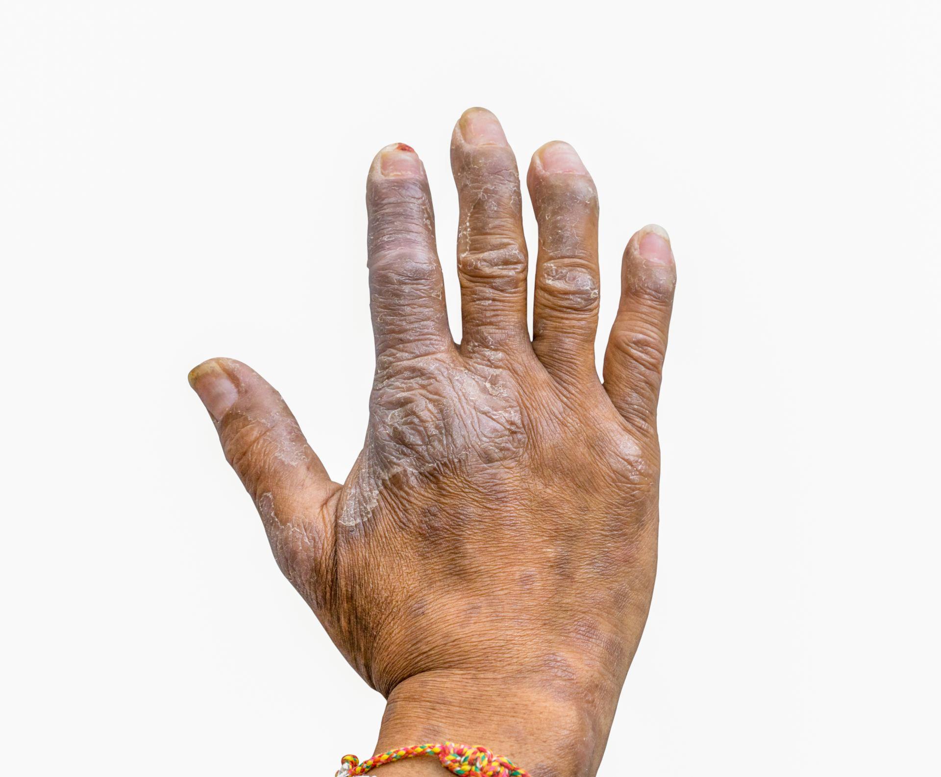 Eczema image