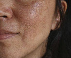 Melasma image