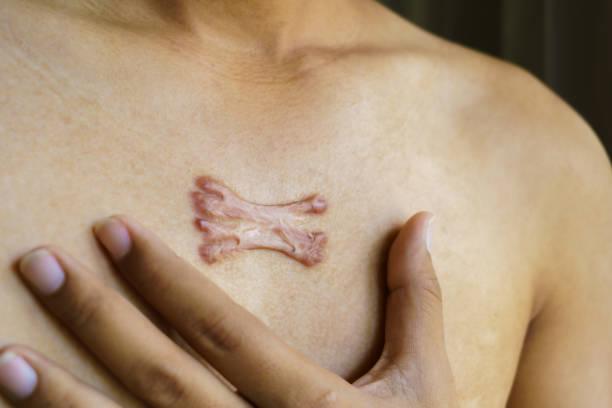 Keloids image