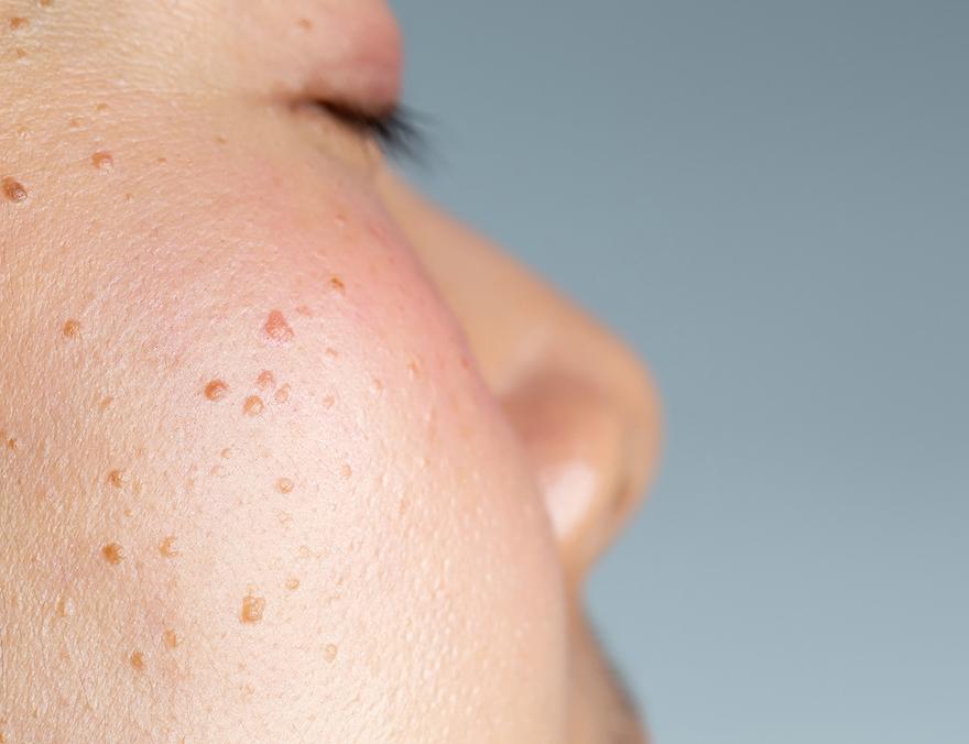 Seborrheic Keratosis image