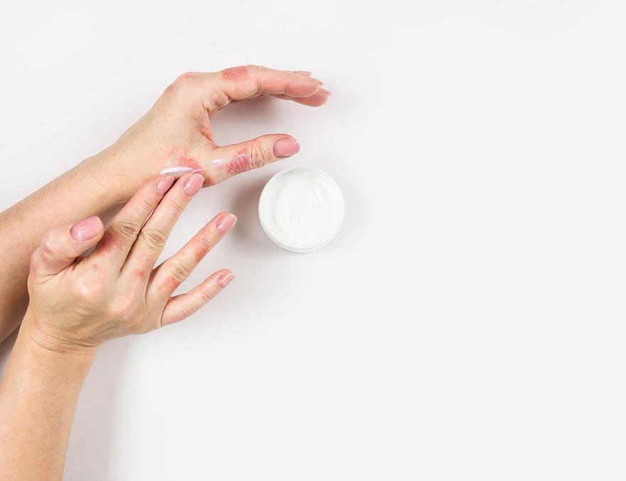 Psoriasis image