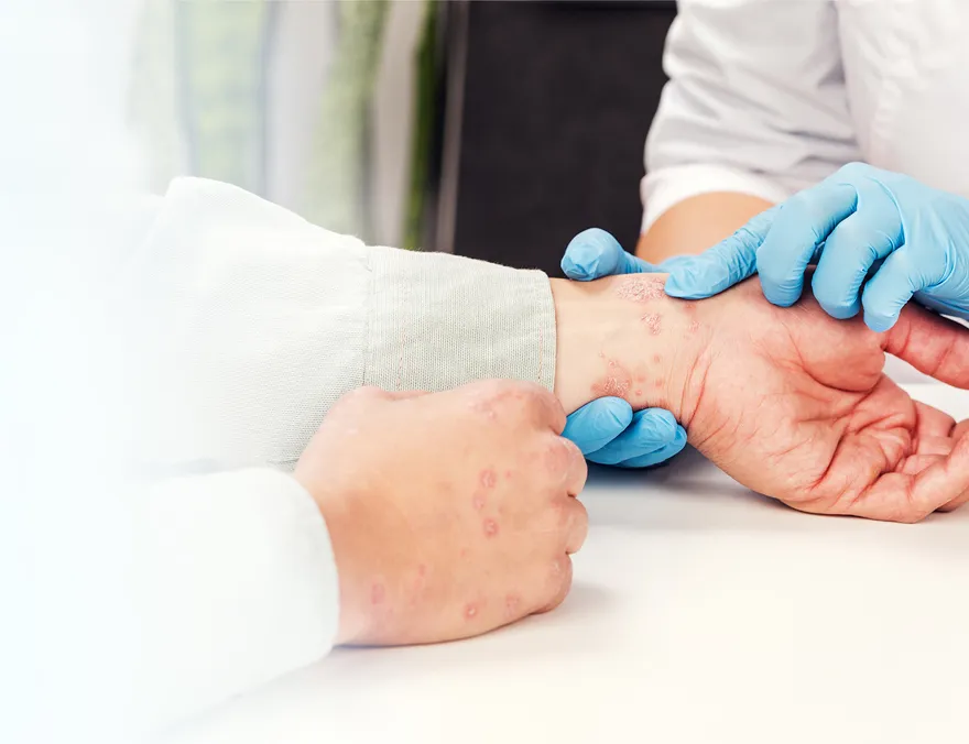 Hand Dermatitis image