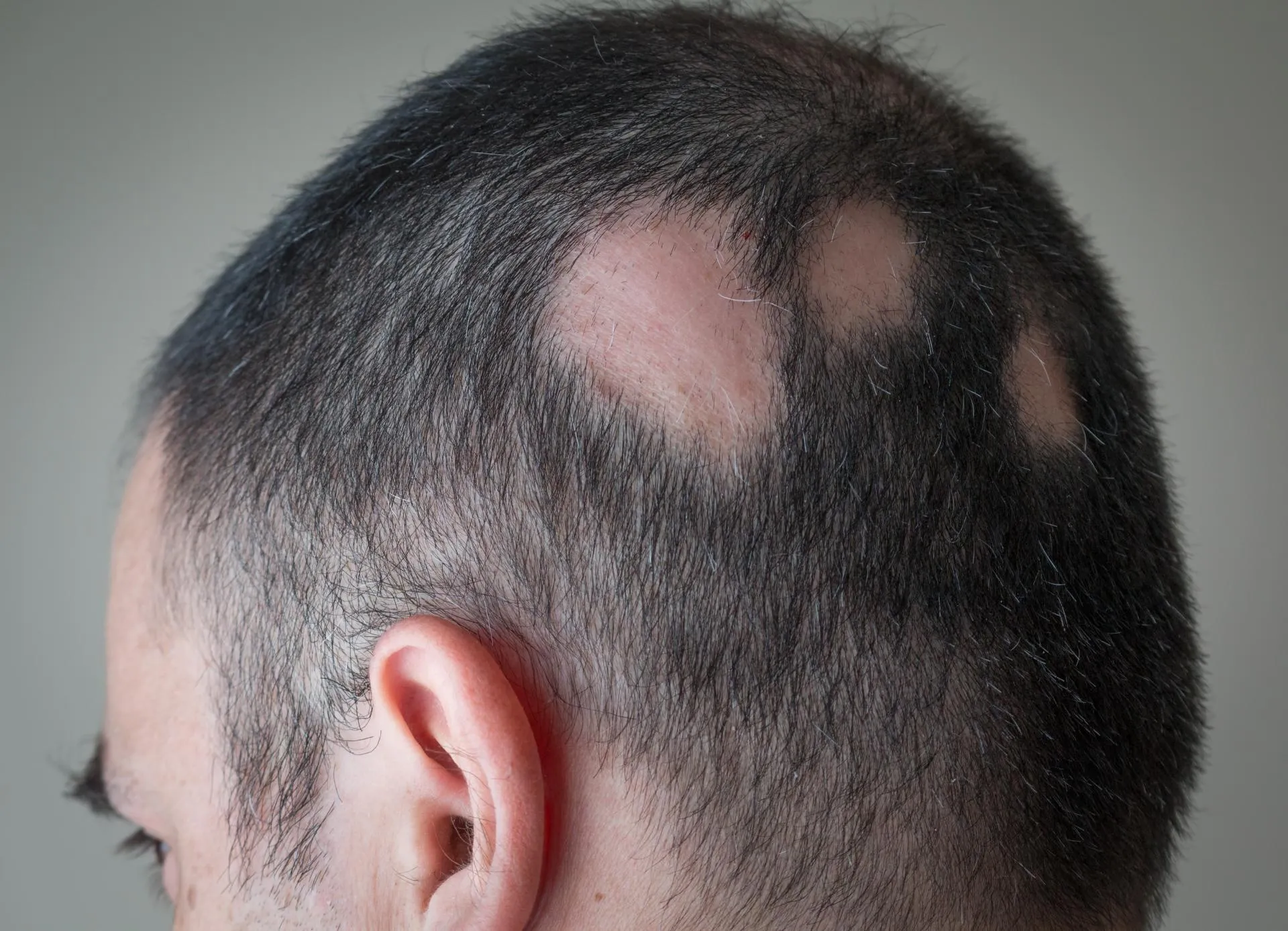 Alopecia Areata image
