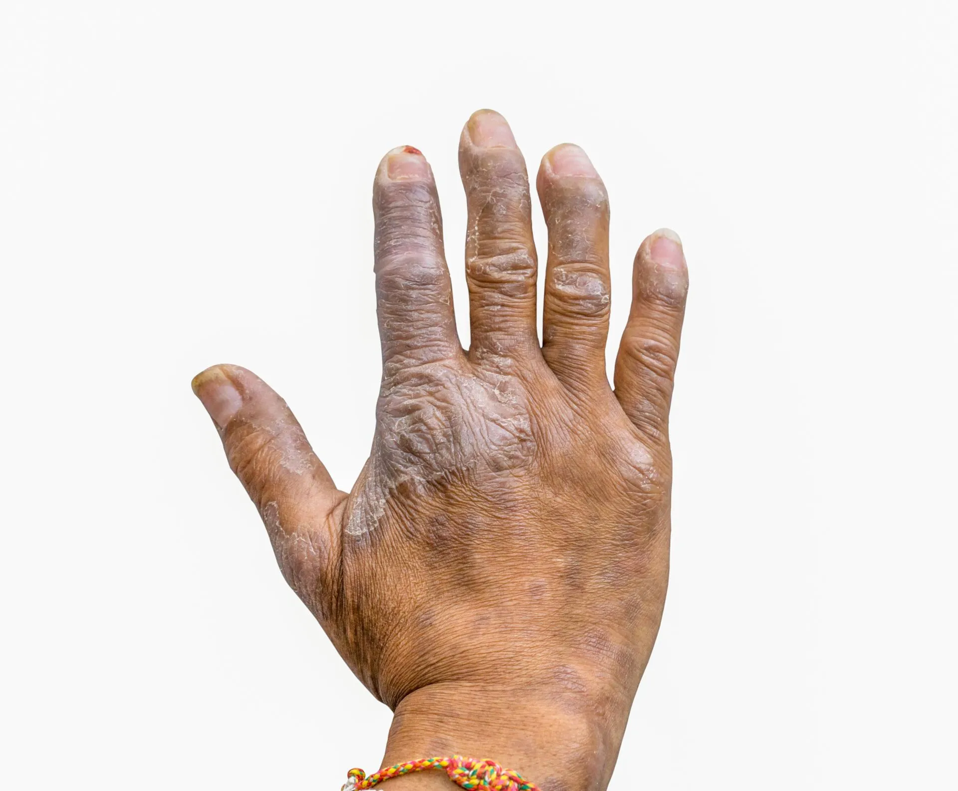 Eczema image