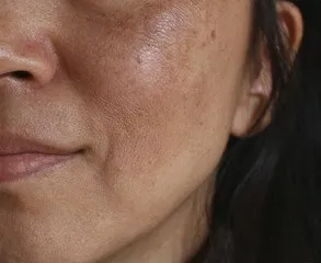 Melasma image