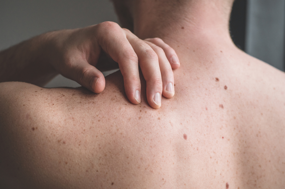Does Self-Screening Really Help Catch Skin Cancer?