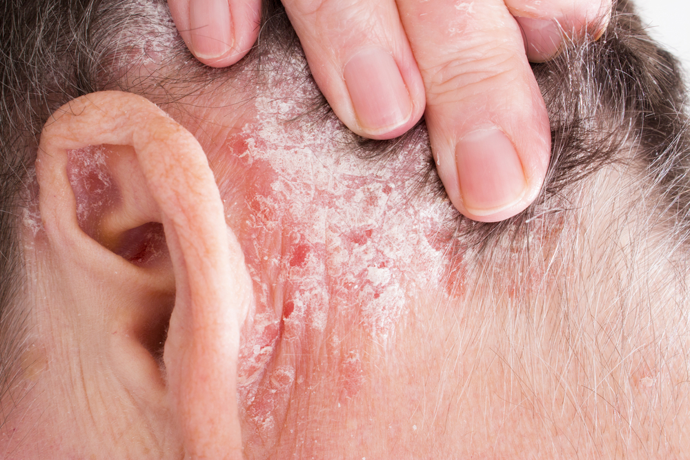 Expert Tips To Prevent Psoriasis Flares
