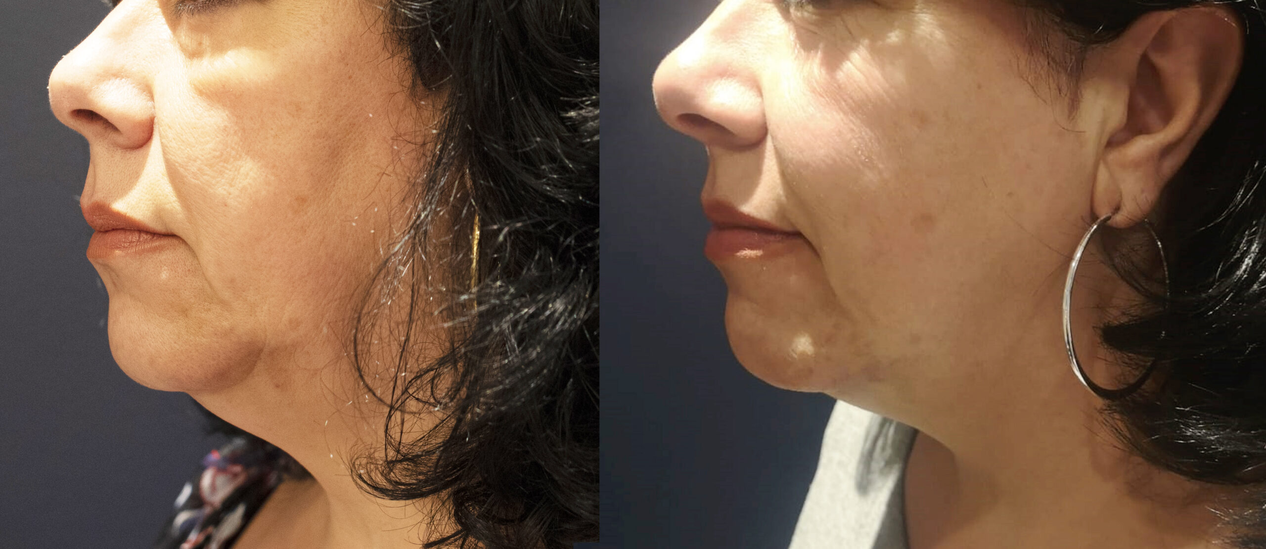Morpheus8 Before and After Collagen