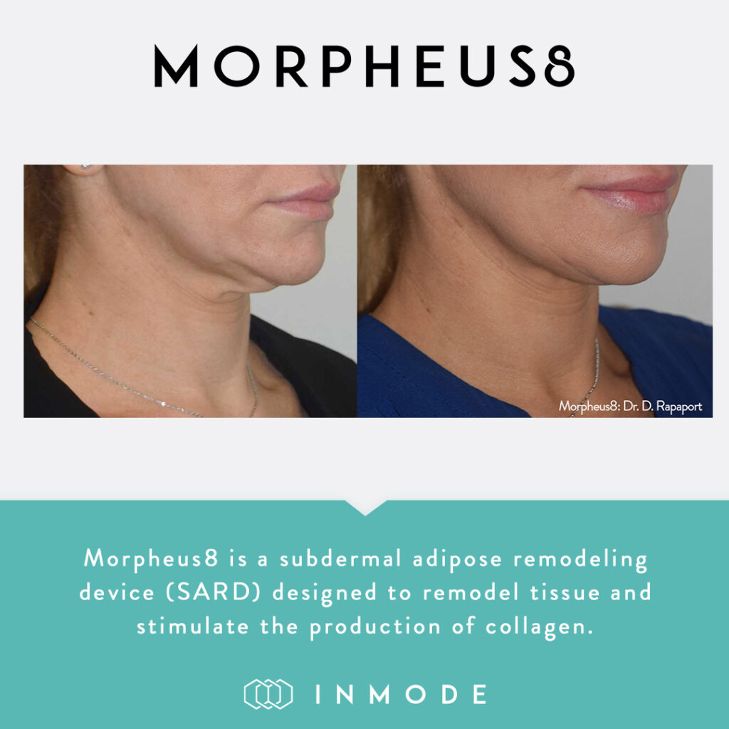 Morpheus8 Collagen Stimulation