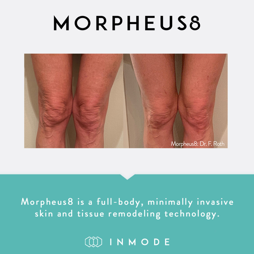 morpheus8 before & after 5