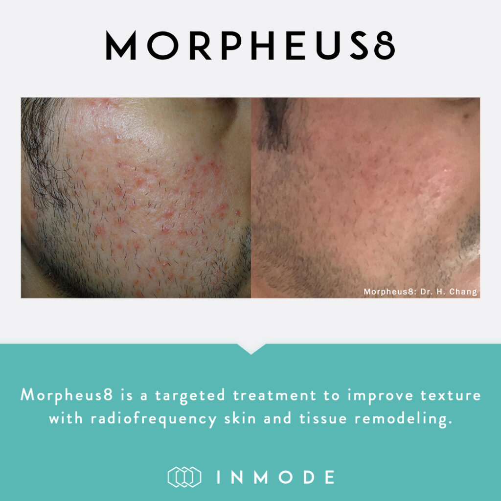 morpheus8 before & after 6