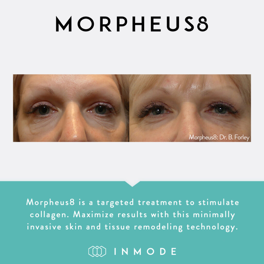 morpheus8 before & after 9
