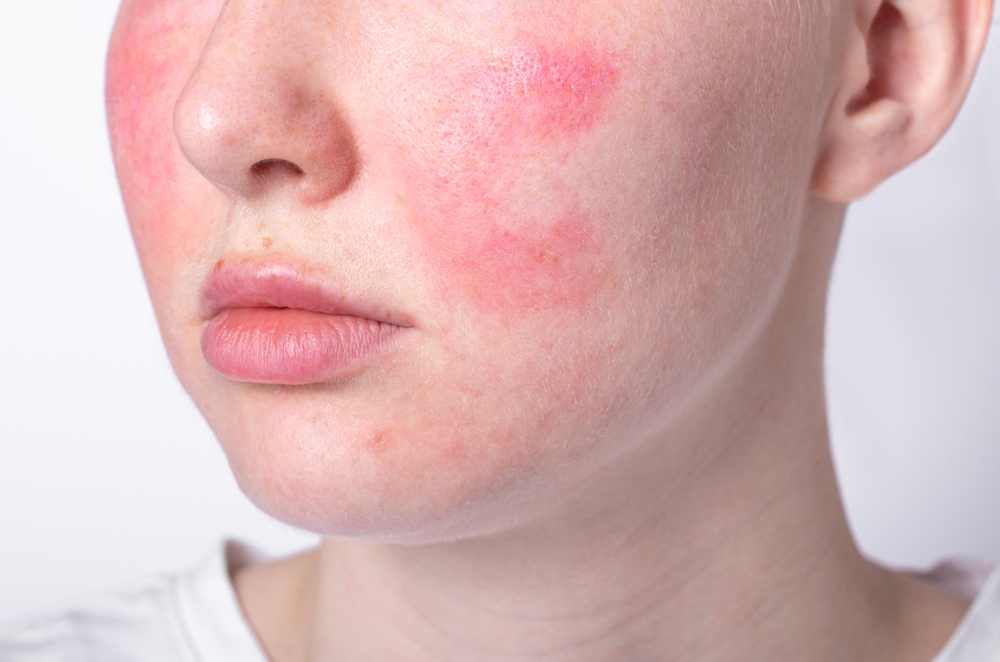 Treatment Options For Managing Rosacea