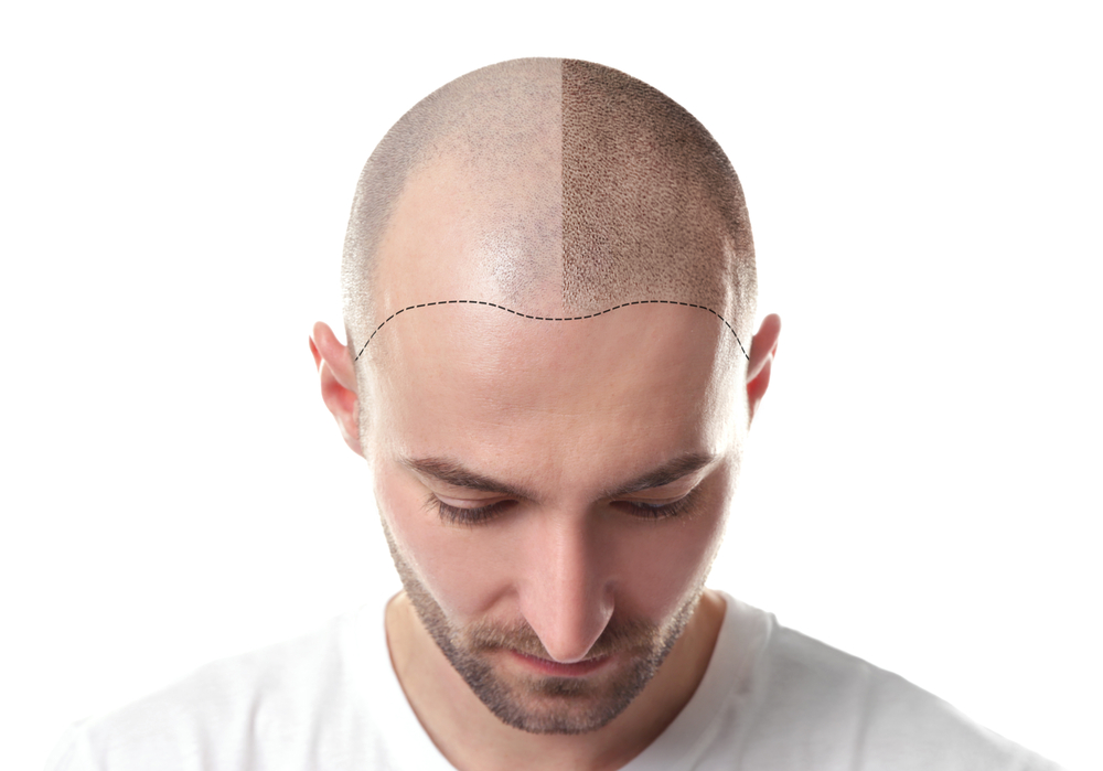 The Connection Between Hair Loss & Dermatological Conditions